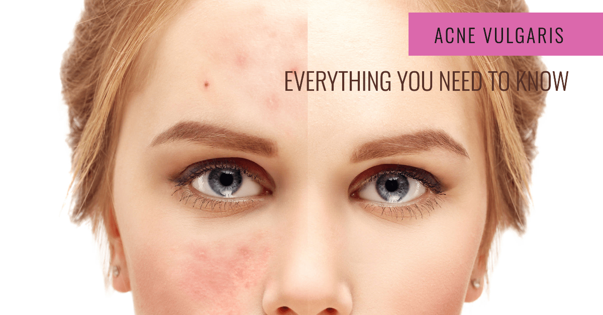 Acne: Types, Causes & Treatment. Everything You Need To Know.