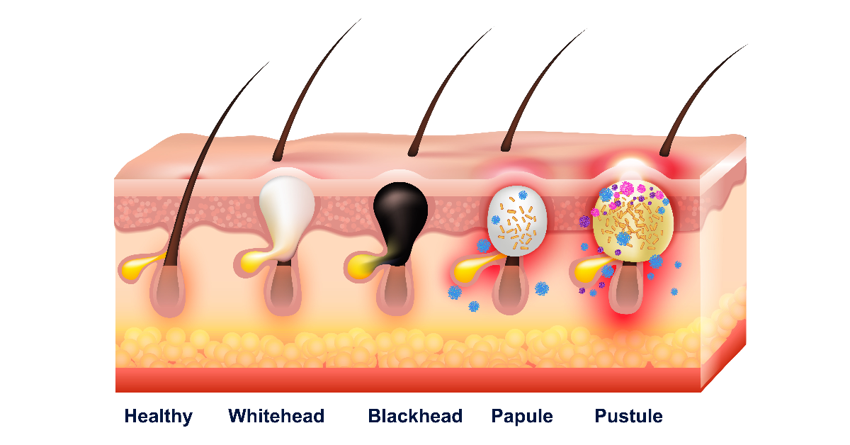 Acne Vulgaris: Types, Causes & Treatment. Everything You Need To Know.
